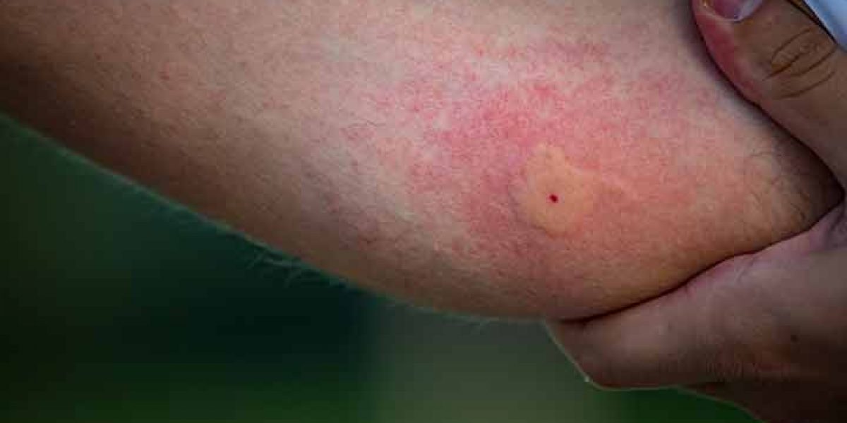 mosquito bite